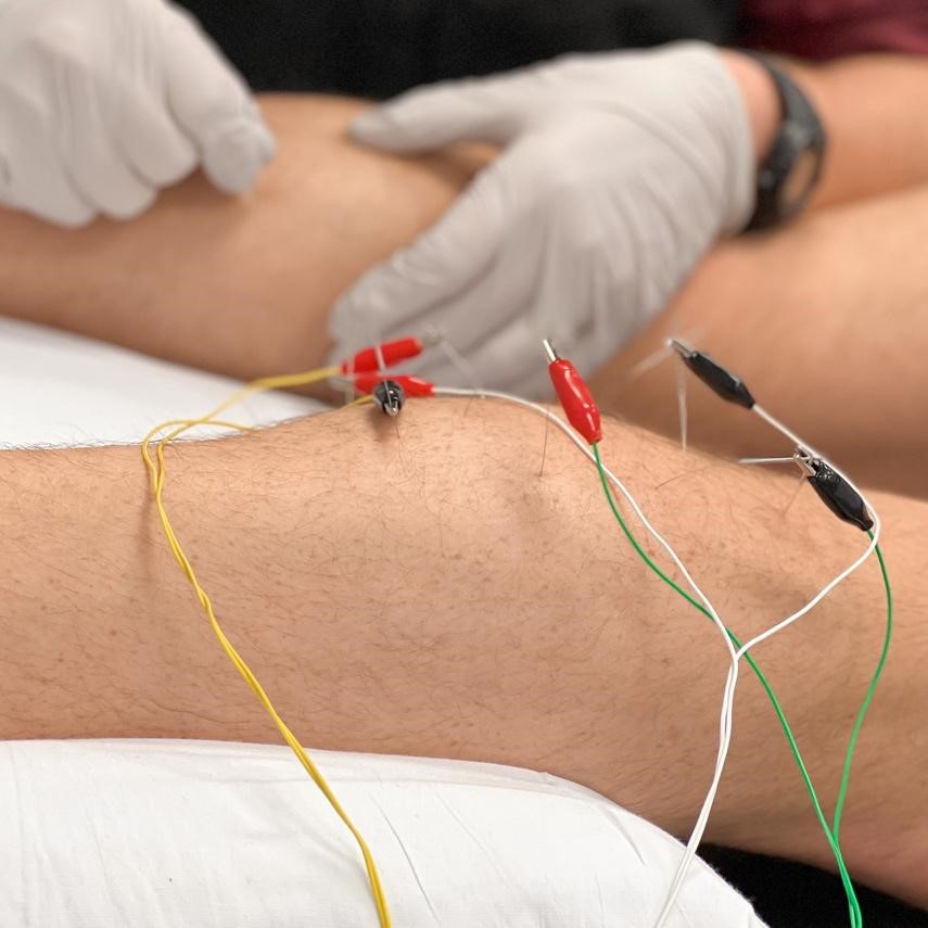 Dry Needling – Coming Soon!