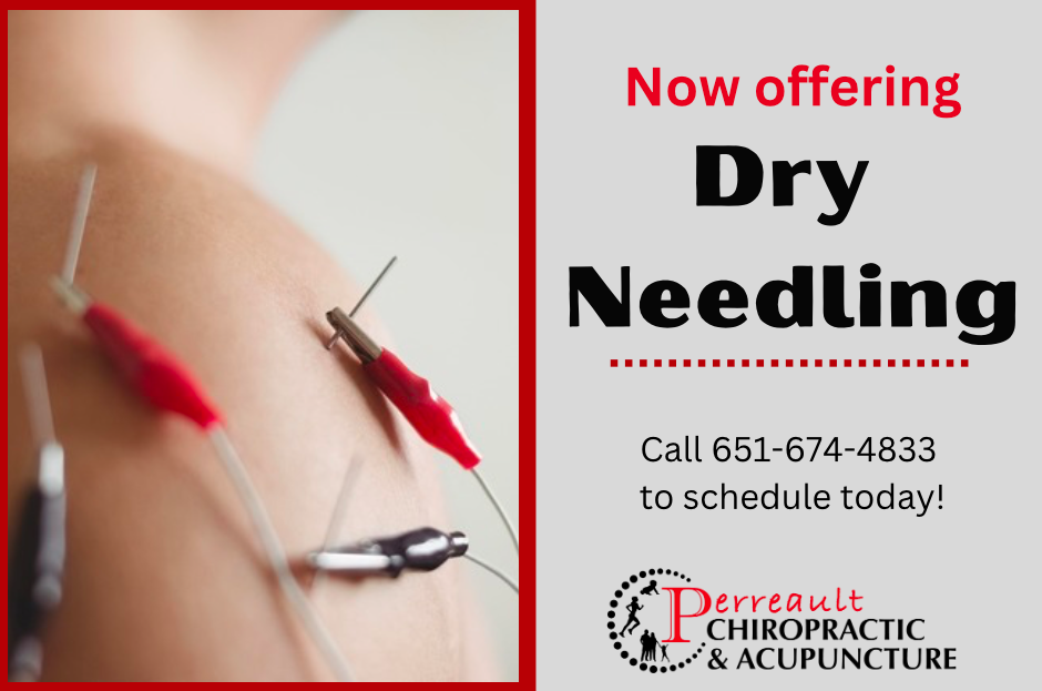 Dry Needling